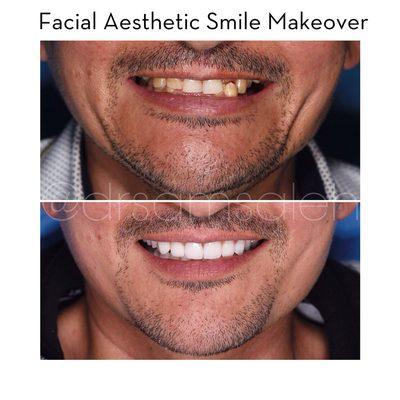 Porcelain Crowns and Veneers Treatment to reposition the jaws for a Facial Aesthetic Smile Makeover.