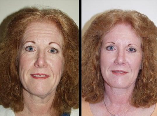 This patient received a face and neck lift in conjunction with an eyelid lift and corrigator muscle resection.