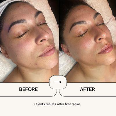 Facial results