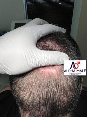 Scar before scalp micropigmentation