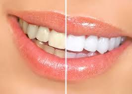 We offer ZOOM whitening and other whitening products to keep your teeth shining bright!