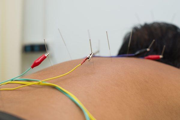 Dry needling with electrical stimulation