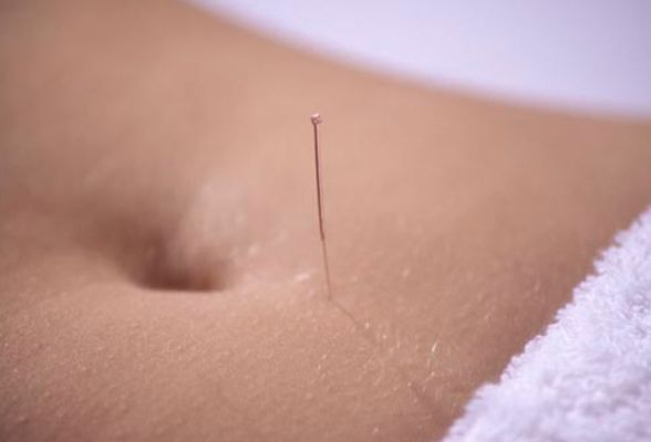 Fertility acupuncture