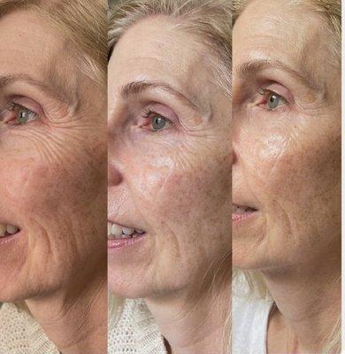 VTox treatment before & after