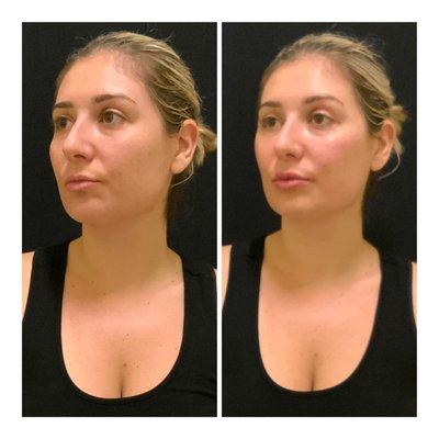 Lip + Cheek Augmentation