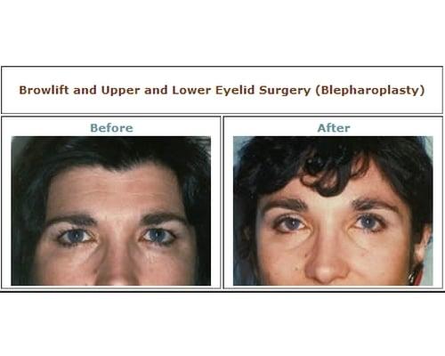 Eyelid Surgery