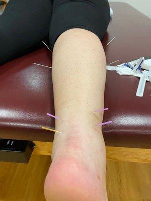 Dry needling