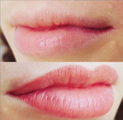 Lips before/after