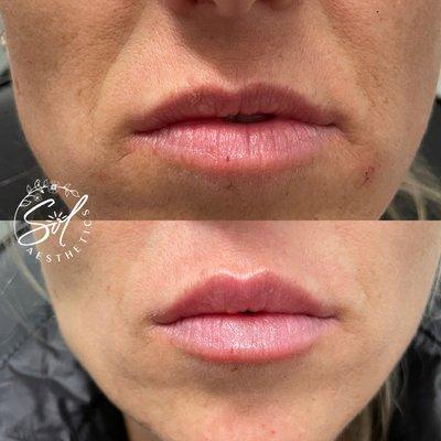 Dermal filler, Lip filler, lip augmentation