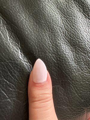 Misshapen nail