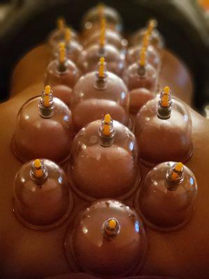 Cupping Therapy