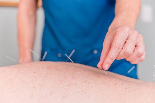 Acupuncture for Back Pain... what ever the cause...give acupuncture a chance to help. Your body will thank you!!