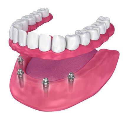 Our dental office offers dentures to replace missing teeth. Dentures are removable teeth replacements, which are also known a...