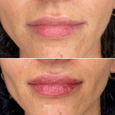 Hydrated and full lips using fillers