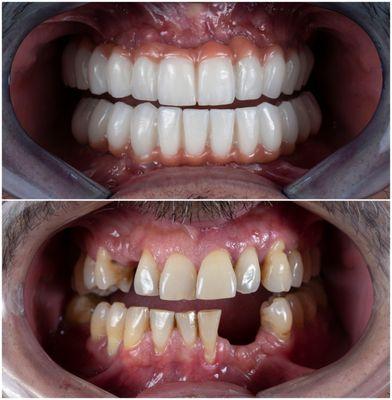 Full mouth extraction and reconstruction with implant fixed zirconia hybrid denture.