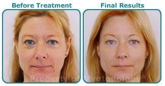 Myotonology-A non surgical alternative to a facelift