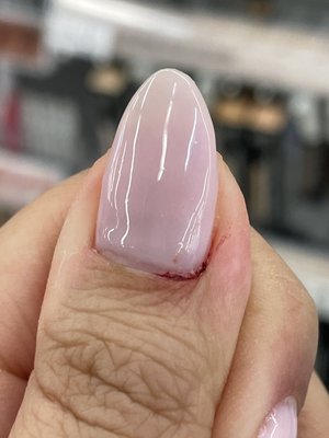 bleeding nail