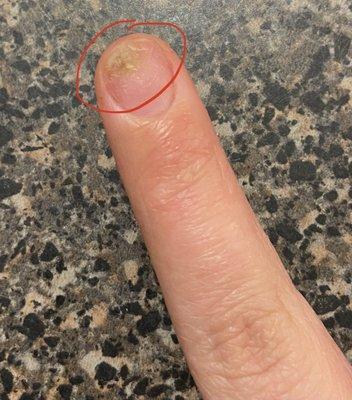 Bacteria growing on nail due to poor application of acrylics