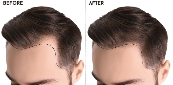 FUE Hair Transplant