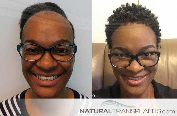 Traction Alopecia Hairline Surgery