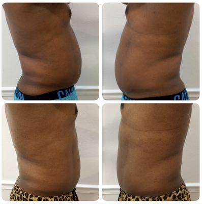 Body Contouring- Before and After. Only 5 sessions!