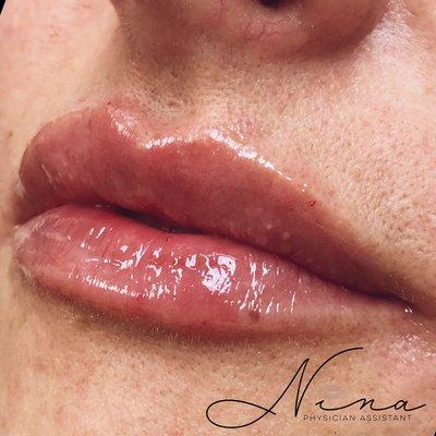 Lip filler by our PA Nina, like and follow on IG for more before and afters! @ninavitalpac