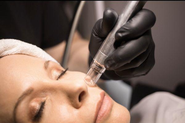 Microdermabrasion