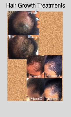 Hair Regrowth Treatments