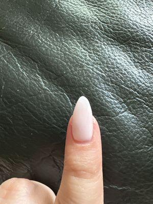 Misshapen pinky nail