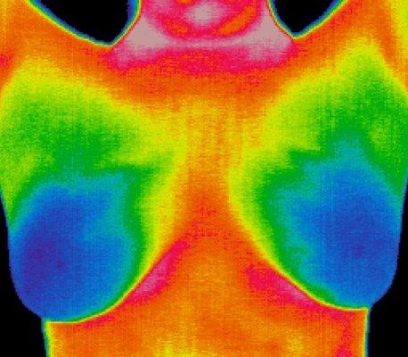 Breast Thermography