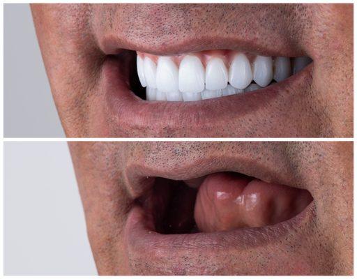 Full mouth reconstruction with fixed implant hybrid Zirconia denture.