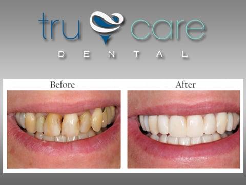 Implant Dentistry Albuquerque, NM