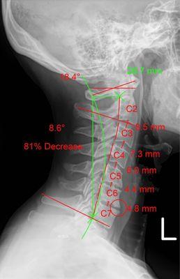 Neck X-ray