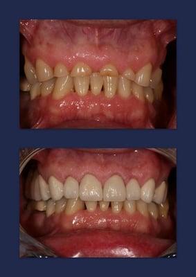 Severe Worned Dentition Reconstruction