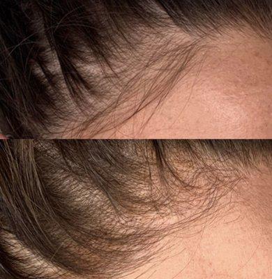 Scalp micro-pigmentation