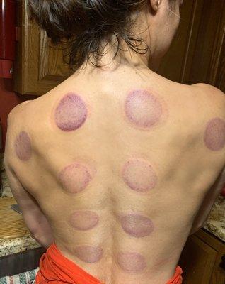 Cupping marks like these represent toxins being lifted out of the deeper tissues of the body, so they can be processed.