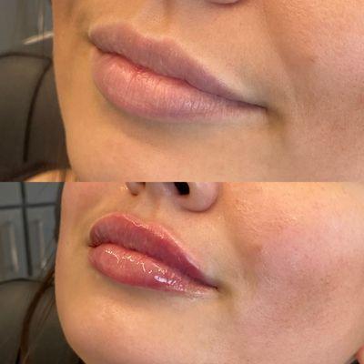 1 ml Juvederm Ultra