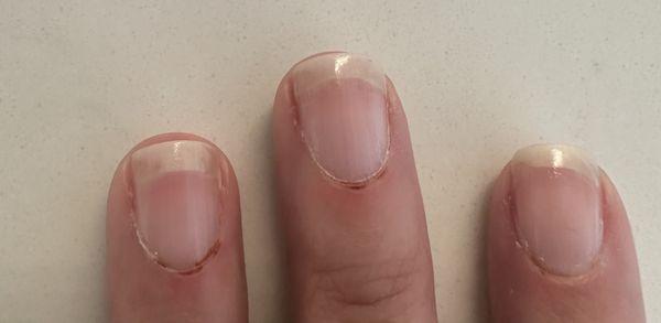 Damaged cuticles