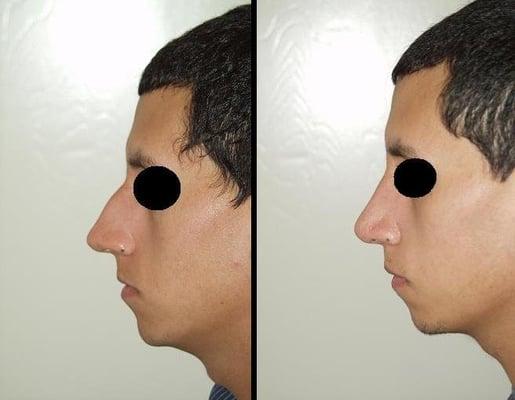 This 23 y/o man underwent a rhinoplasty with septoplasty. After Photos were taken 2 months post-op.