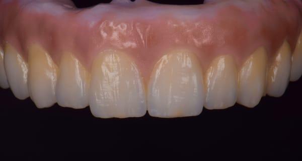 Full arch zirconia hybrid restoration