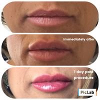 Original, immediately after and one day post lip filler