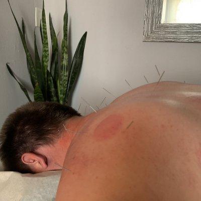 My fiancé after getting cupping done, now it's acupuncture time!