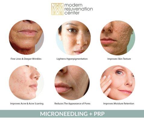 Medical Microneedling with PRP uses the power of your blood's platelets to rejuvenate skin and reinvigorate cellular turnover.