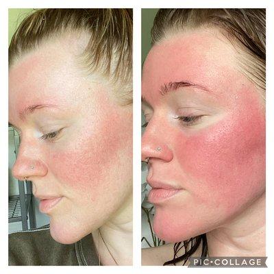 Rosacea