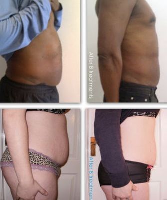 Before and After Laser lipo Treatments