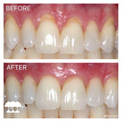 Gum Recession Before & After