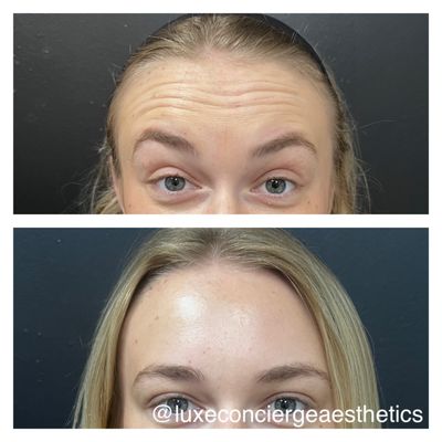 Jeuveau results 2 weeks after treatments.  No more wrinkles!