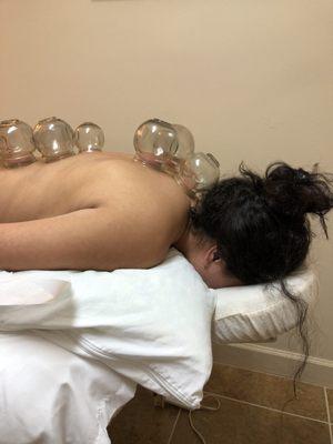 Cupping....No pain at all.