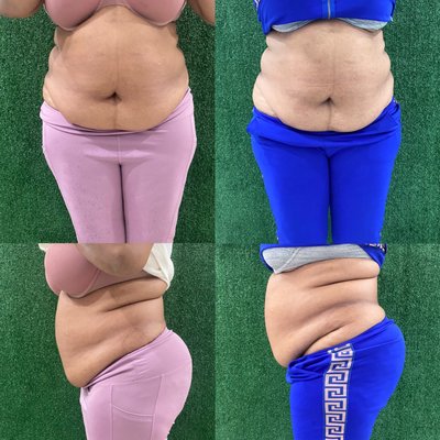 Slimming shot/lipo dissolve