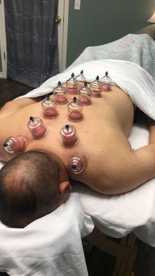 Cupping Therapy